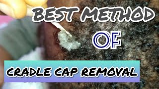 COMPLETE REMOVAL OF CRADLE CAP IN ONE DAY CRADLE CAP IN BABIES [upl. by Landre493]