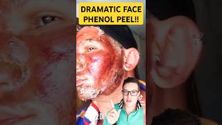 Dangerous CHEMICAL PEEL Results  Phenol Peel Before and After  shorts [upl. by Attenod]