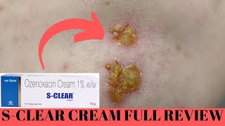 SClear Cream Review Conquering Impetigo with Skincare Magic 🌿✨  Your Ultimate Healing Solution [upl. by Jutta]