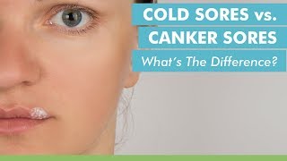 Cold Sores vs Canker Sores Whats The Difference [upl. by Eva491]