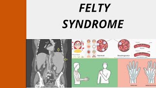 Felty Syndrome FS Mnemonic [upl. by Breban]