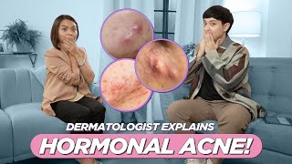 How to Treat CYSTIC amp HORMONAL ACNE Derma Answers Medications Causes Lifestyle etc Filipino [upl. by Lebna]