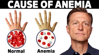 The Hidden Cause of Anemia Youve Never Heard About [upl. by Maloney]