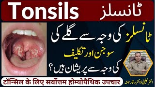 Tonsils گلے کی سوجن اور تکلیف टॉन्सिल Homeopathic Treatmennt By Dr Waqar Bhutta In Urdu  Hindi [upl. by Ihcur562]