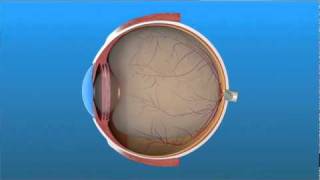 Vitrectomy Surgery for Detached Retina [upl. by Aihsened]