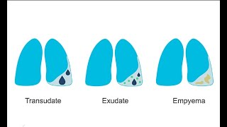 How to recognize different pleural effusions on chest CT [upl. by Dnaltroc]