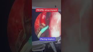 How we use PROPEL sinus implants after sinus surgery for optimal healing [upl. by Liesa886]