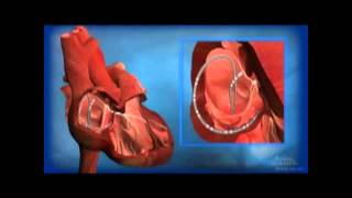 Ablation for AV Node Reentrant Tachycardia AVNRT [upl. by Oiril]