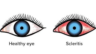 ScleritisEpiscleritis  in very easy way eyedisorders scleritis episcleritis shalakyatantra [upl. by Nauqram903]