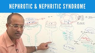 Nephrotic and Nephritic Syndrome  Causes Symptoms amp Treatment🩺 [upl. by Stroup770]