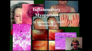 14 Inflammatory Myopathy Dermatomyositis Polymyositis Inclusion Body Myositis and others [upl. by Wolfram90]