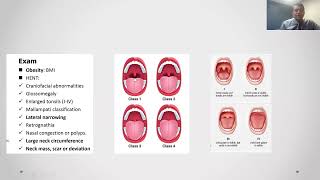 Obstructive Sleep Apnea  Diagnosis and Treatment [upl. by Lenci]