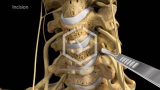 c5c6c7 Anterior Cervical Discectomy with Fusion [upl. by Pearle]