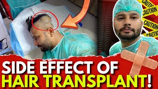 Hair transplant Review In Pakistan  Experience Of Hair Transplant Again Transplant [upl. by Andrei]