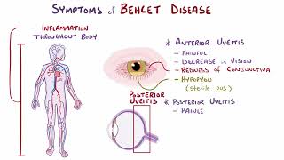 Behcet Disease  Osmosis [upl. by Marelda674]