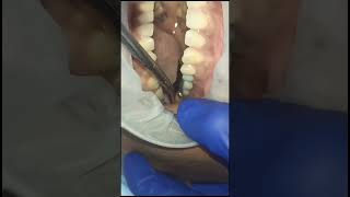 Left upper premolar molar replacement with basal implants and g cam bridge 40 micron clearance test [upl. by Nowaj340]