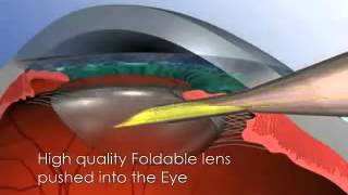 Phaco Cataract surgery animation [upl. by Ahsiki]