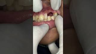 Broken incisor and discolouration after trauma umairtoothfairy viral shorts Umairazeem8553 [upl. by Newbill]