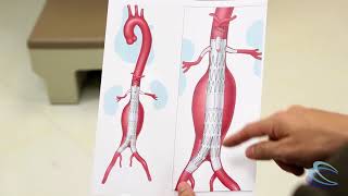 Complex Abdominal Aortic Aneurysm Surgery [upl. by Yukio]