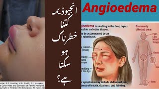 Angioedema Urdu video [upl. by Evelyn23]