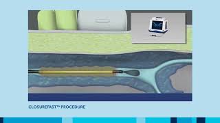 ClosureFast Procedure for Varicose Vein treatment [upl. by Burnley]