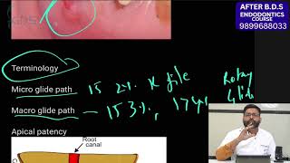 Glidepath Made Easy Tips and Tricks for Smooth Root Canal Treatment in Hindi [upl. by Ococ327]