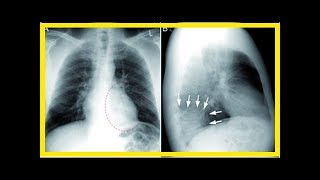 Behandlung von atypischer Pneumonie [upl. by Nahtaj]