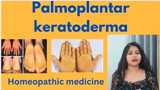 Palmoplantar keratoderma treatment  Palmoplantar keratoderma symptomscauses amp homeopathic medicine [upl. by Ahsino]