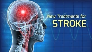 Innovations in the Treatment of Stroke  Health Matters [upl. by Engedus]