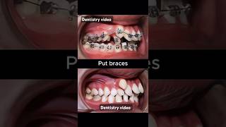 Braces are very crooked teeth braces orthodontist dentistry dentist allaboutbraces [upl. by Feingold]