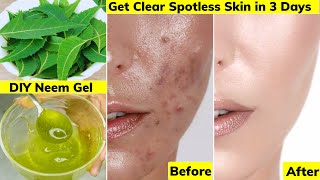 I applied👆🏼this Face Cream Gel on Acne Pimples PigmentationBumpsGot Clear Glowing Skin in 3 Days [upl. by Gnuy]