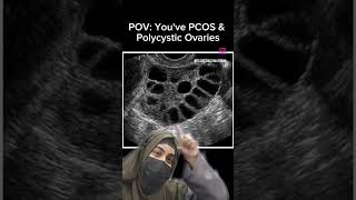 😀Polycystic Ovaries is a common symptom of PCOS Suxh ultrasound shows that you have PCOS pcos [upl. by Habeh96]