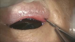 Punch punctoplasty for punctal stenosis by Dr Hunter Yuen [upl. by Ellennod256]