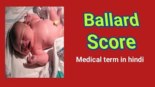 Ballard ScoreMedical term in hindi [upl. by Linea]