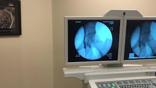 IntraArticular Injection of the Hip Under Fluoroscopic Guidance [upl. by Lorianne755]