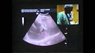 IR Liver Cancer Live Microwave Ablation Treatment without Surgery  Dr Samir Abdelghaffar [upl. by Ingraham]