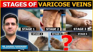 What are the stages of Varicose Veins   Dr Gaurav Gangwani Interventional Radiologist [upl. by Sol]