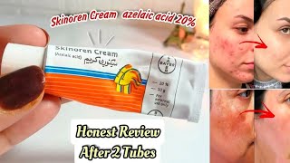 SKINOREN CREAM BEFORE AND AFTER  SKINOREN CREAM REVIEW [upl. by Corb999]