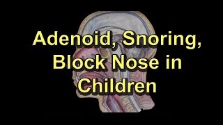 Adenoiditis Adenoid Surgery Snoring Block noseRunny nose in children [upl. by Dirraj]