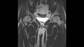 Cam type femoroacetabular impingement FAI and ischiofemoral impingement [upl. by Alleunam]