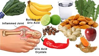 GOUT TREATMENT How To Cure Gout Fast At Home With Natural Remedies  Health 24H [upl. by Keithley]