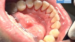 Periodontal treatment protocol [upl. by Boote]