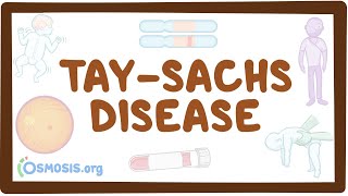 TaySachs disease  causes symptoms diagnosis treatment pathology [upl. by Ecinaj864]