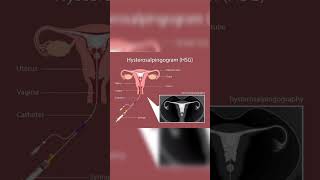 Hysterosalpingography  Salpingitis  Fallopian tube blockage  Nodular diverticulaeInfertility [upl. by Nedarb]