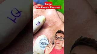 CRAZY BLACKHEAD REMOVAL  Huge Blackheads On Nose shorts [upl. by Antoine]