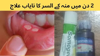 Quick Relief Home Remedies to Cure Mouth Ulcers Fast [upl. by Eraste]