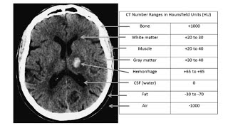 CT Physics Beam attenuation Hounsfield units [upl. by Baldridge]