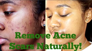 How to Remove My Acne Scars Naturally Essential Oils Derma Roller  More [upl. by Eatnad166]