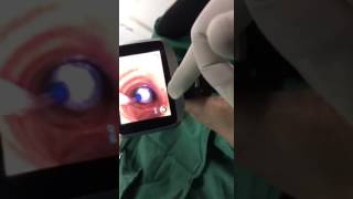 Insighters Video Flexible Laryngoscope iS3CF [upl. by Enyala]