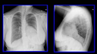 PHRENIC NERVE INJURY CAUSING DIAPHRAGM EVENTRATION XRAY patientsafety FOAMRAD [upl. by Boycey]